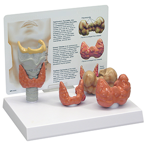 Common Goiter Model